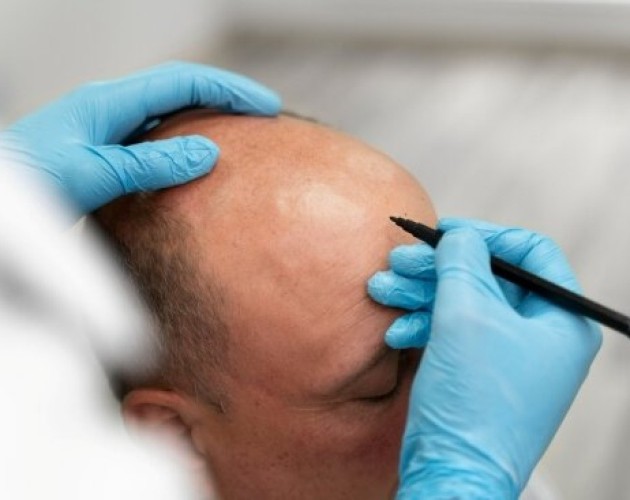 Trasplante capilar Madrid